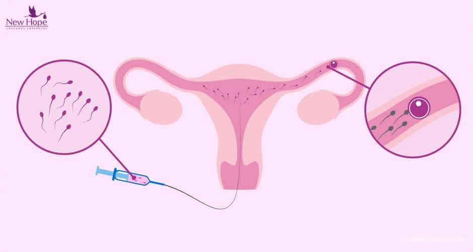 Inseminación intrauterina