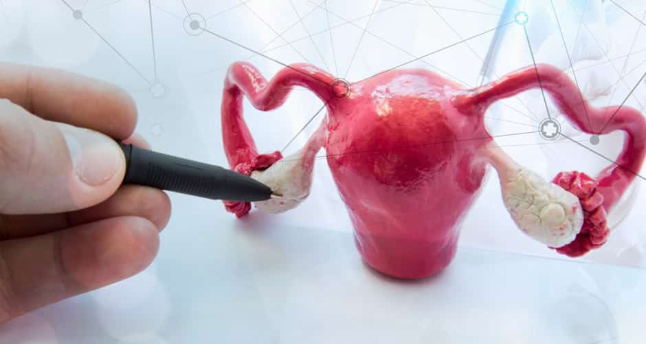 ¿Puedo embarazarme con ovario poliquístico?